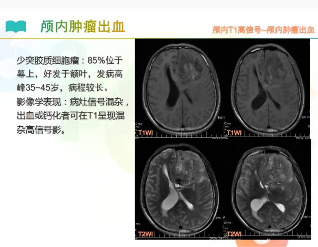 【PPT】颅内T1高信号疾病解读