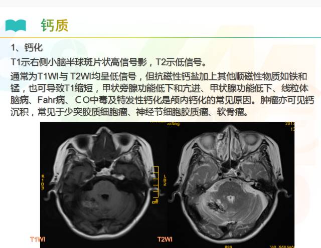 【PPT】颅内T1高信号疾病解读