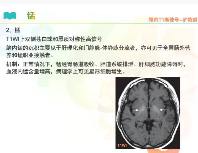 【PPT】颅内T1高信号疾病解读