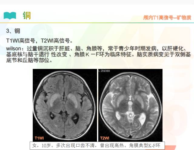 【PPT】颅内T1高信号疾病解读