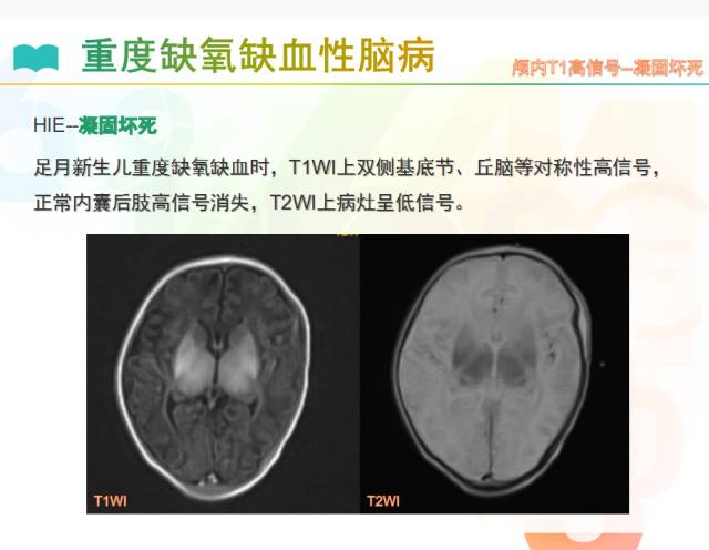 【PPT】颅内T1高信号疾病解读