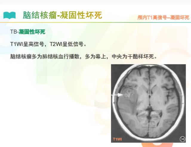 【PPT】颅内T1高信号疾病解读