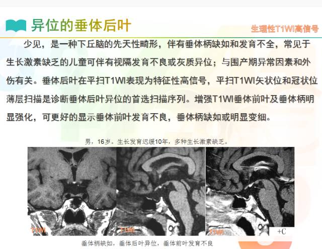 【PPT】颅内T1高信号疾病解读