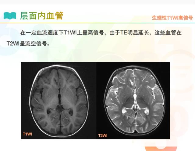 【PPT】颅内T1高信号疾病解读