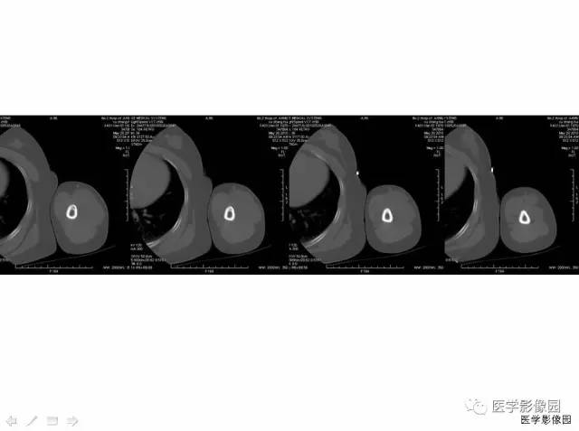 【病例】左上臂腹壁外韧带样纤维瘤1例CT及MR 【病例】左上臂腹壁外韧带样纤维瘤1例CT及MR