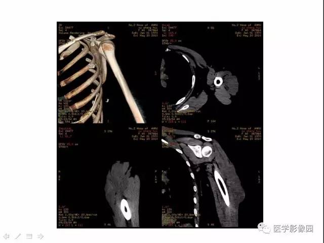 【病例】左上臂腹壁外韧带样纤维瘤1例CT及MR 【病例】左上臂腹壁外韧带样纤维瘤1例CT及MR