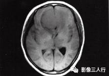 【病例】嗅沟脑膜瘤1例MR影像表现 【病例】嗅沟脑膜瘤1例MR影像表现