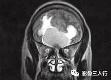 【病例】嗅沟脑膜瘤1例MR影像表现 【病例】嗅沟脑膜瘤1例MR影像表现
