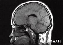 【病例】嗅沟脑膜瘤1例MR影像表现 【病例】嗅沟脑膜瘤1例MR影像表现