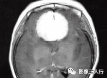 【病例】嗅沟脑膜瘤1例MR影像表现 【病例】嗅沟脑膜瘤1例MR影像表现