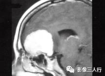 【病例】嗅沟脑膜瘤1例MR影像表现 【病例】嗅沟脑膜瘤1例MR影像表现