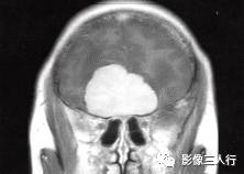 【病例】嗅沟脑膜瘤1例MR影像表现