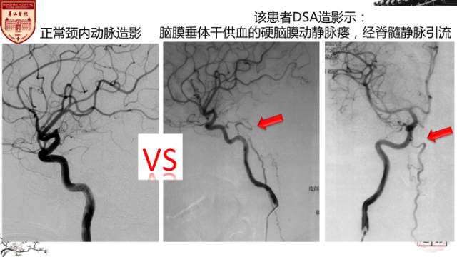 【病例】硬脑膜动静脉瘘1例MR影像表现分析 【病例】硬脑膜动静脉瘘1例MR影像表现分析