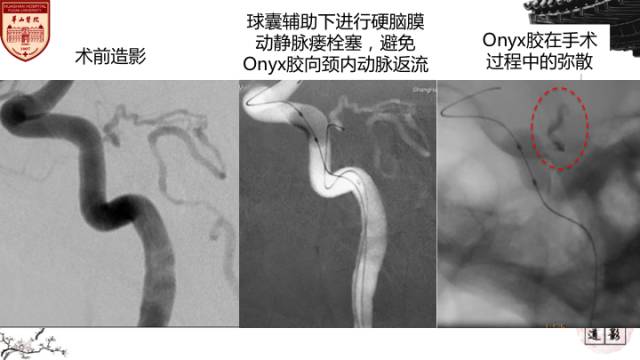 【病例】硬脑膜动静脉瘘1例MR影像表现分析 【病例】硬脑膜动静脉瘘1例MR影像表现分析