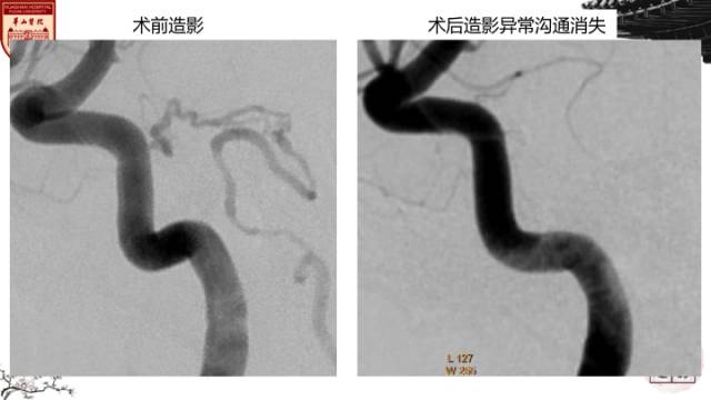 【病例】硬脑膜动静脉瘘1例MR影像表现分析 【病例】硬脑膜动静脉瘘1例MR影像表现分析