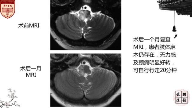 【病例】硬脑膜动静脉瘘1例MR影像表现分析 【病例】硬脑膜动静脉瘘1例MR影像表现分析