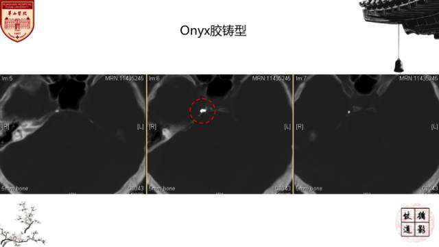 【病例】硬脑膜动静脉瘘1例MR影像表现分析 【病例】硬脑膜动静脉瘘1例MR影像表现分析