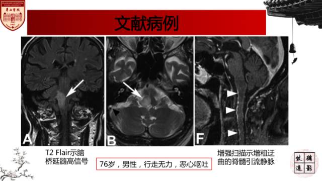 【病例】硬脑膜动静脉瘘1例MR影像表现分析 【病例】硬脑膜动静脉瘘1例MR影像表现分析
