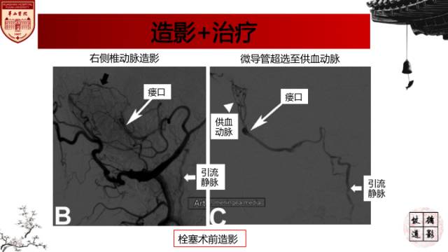 【病例】硬脑膜动静脉瘘1例MR影像表现分析 【病例】硬脑膜动静脉瘘1例MR影像表现分析