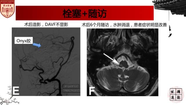【病例】硬脑膜动静脉瘘1例MR影像表现分析 【病例】硬脑膜动静脉瘘1例MR影像表现分析