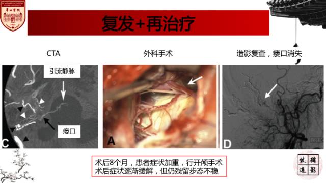 【病例】硬脑膜动静脉瘘1例MR影像表现分析 【病例】硬脑膜动静脉瘘1例MR影像表现分析