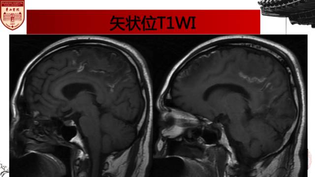 【病例】中枢神经系统血管炎1例MR影响表现 【病例】中枢神经系统血管炎1例MR影响表现