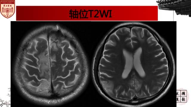 【病例】中枢神经系统血管炎1例MR影响表现 【病例】中枢神经系统血管炎1例MR影响表现