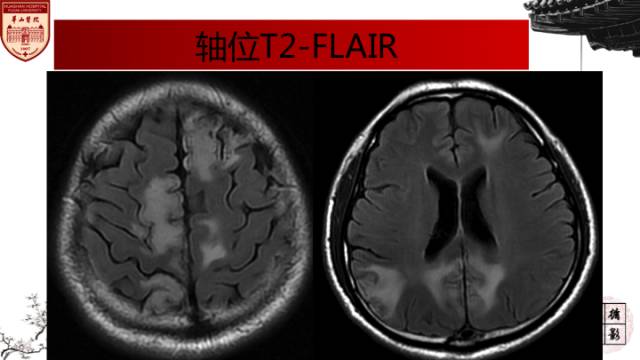 【病例】中枢神经系统血管炎1例MR影响表现 【病例】中枢神经系统血管炎1例MR影响表现