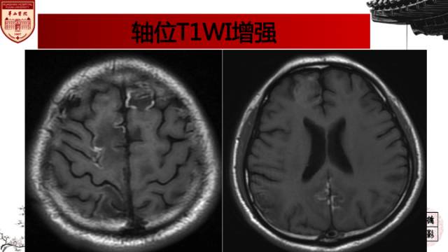 【病例】中枢神经系统血管炎1例MR影响表现 【病例】中枢神经系统血管炎1例MR影响表现