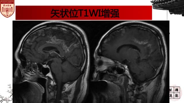 【病例】中枢神经系统血管炎1例MR影响表现 【病例】中枢神经系统血管炎1例MR影响表现