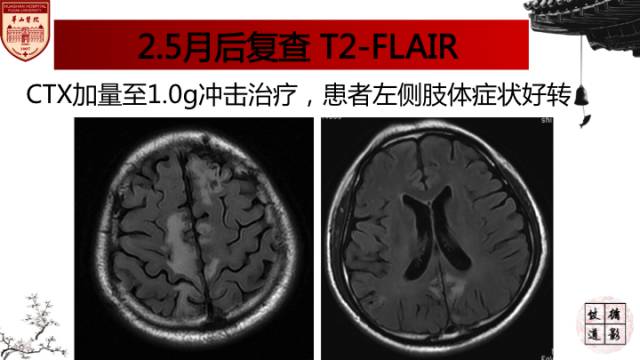 【病例】中枢神经系统血管炎1例MR影响表现 【病例】中枢神经系统血管炎1例MR影响表现