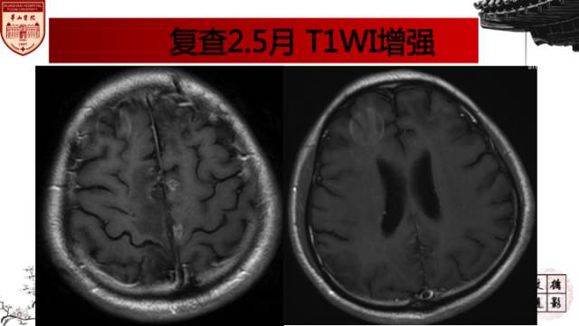 【病例】中枢神经系统血管炎1例MR影响表现 【病例】中枢神经系统血管炎1例MR影响表现