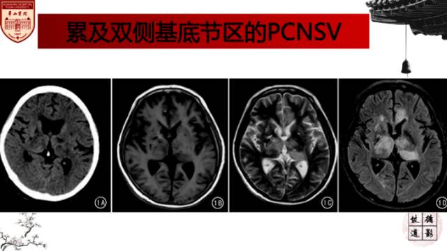 【病例】中枢神经系统血管炎1例MR影响表现 【病例】中枢神经系统血管炎1例MR影响表现