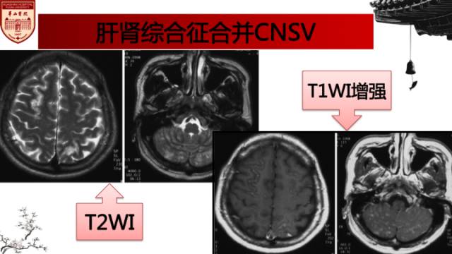 【病例】中枢神经系统血管炎1例MR影响表现 【病例】中枢神经系统血管炎1例MR影响表现