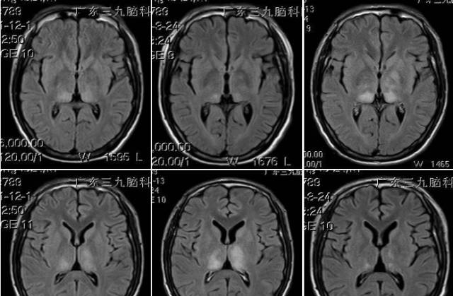 一只蚊子引发的头痛——流行性乙型脑炎 一只蚊子引发的头痛——流行性乙型脑炎