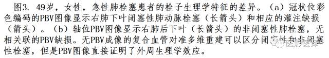 肺动脉高压的双能CT影像:挑战与机遇 肺动脉高压的双能CT影像:挑战与机遇