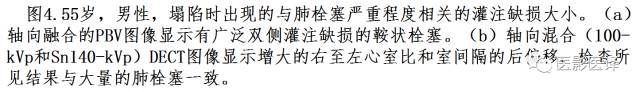 肺动脉高压的双能CT影像:挑战与机遇 肺动脉高压的双能CT影像:挑战与机遇