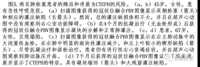 肺动脉高压的双能CT影像:挑战与机遇 肺动脉高压的双能CT影像:挑战与机遇