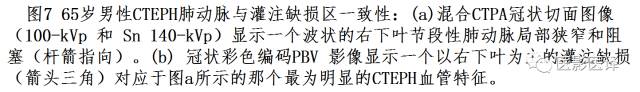 肺动脉高压的双能CT影像:挑战与机遇 肺动脉高压的双能CT影像:挑战与机遇