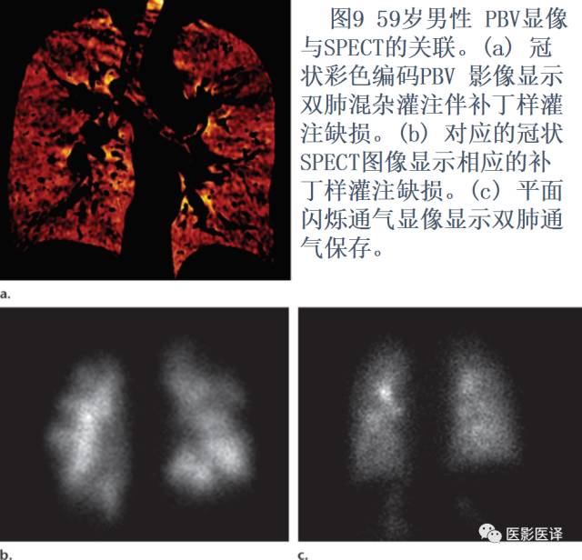肺动脉高压的双能CT影像:挑战与机遇 肺动脉高压的双能CT影像:挑战与机遇
