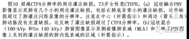 肺动脉高压的双能CT影像:挑战与机遇 肺动脉高压的双能CT影像:挑战与机遇