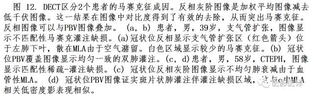肺动脉高压的双能CT影像:挑战与机遇 肺动脉高压的双能CT影像:挑战与机遇