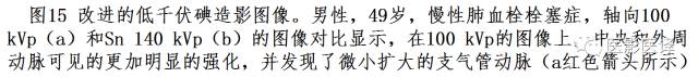 肺动脉高压的双能CT影像:挑战与机遇 肺动脉高压的双能CT影像:挑战与机遇