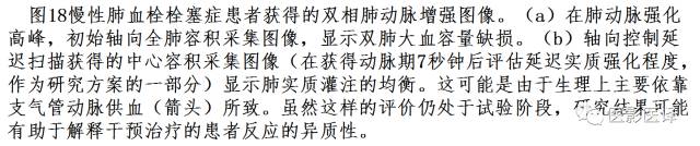 肺动脉高压的双能CT影像:挑战与机遇 肺动脉高压的双能CT影像:挑战与机遇