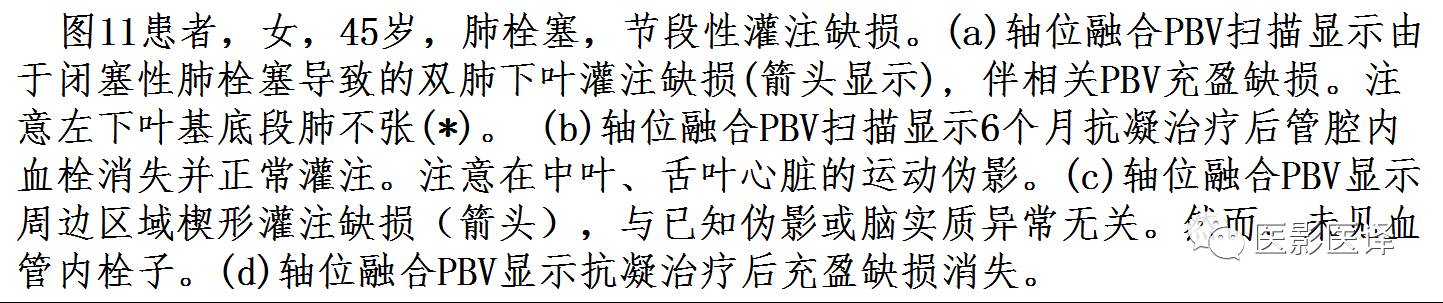 肺动脉高压的双能CT影像:挑战与机遇 肺动脉高压的双能CT影像:挑战与机遇