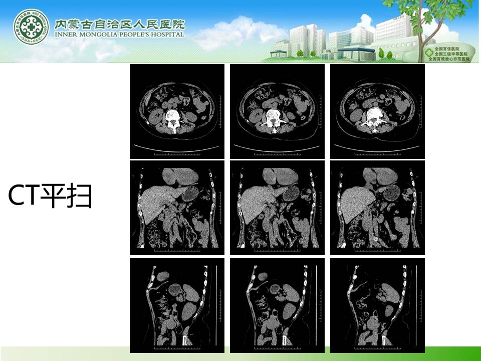 【病例】小肠间质瘤1例CT
