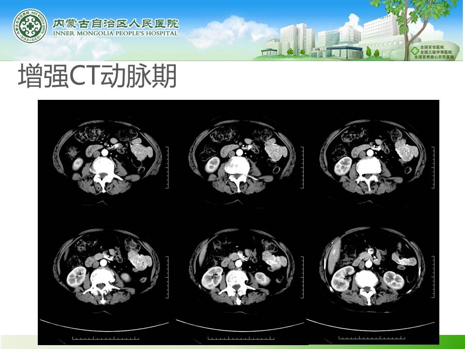 【病例】小肠间质瘤1例CT
