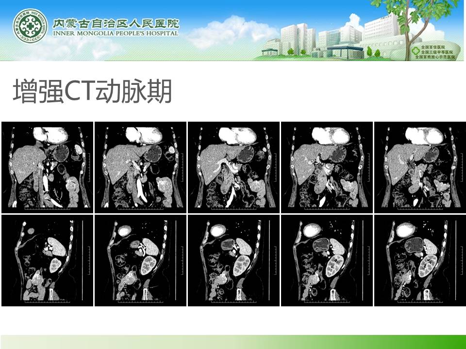【病例】小肠间质瘤1例CT