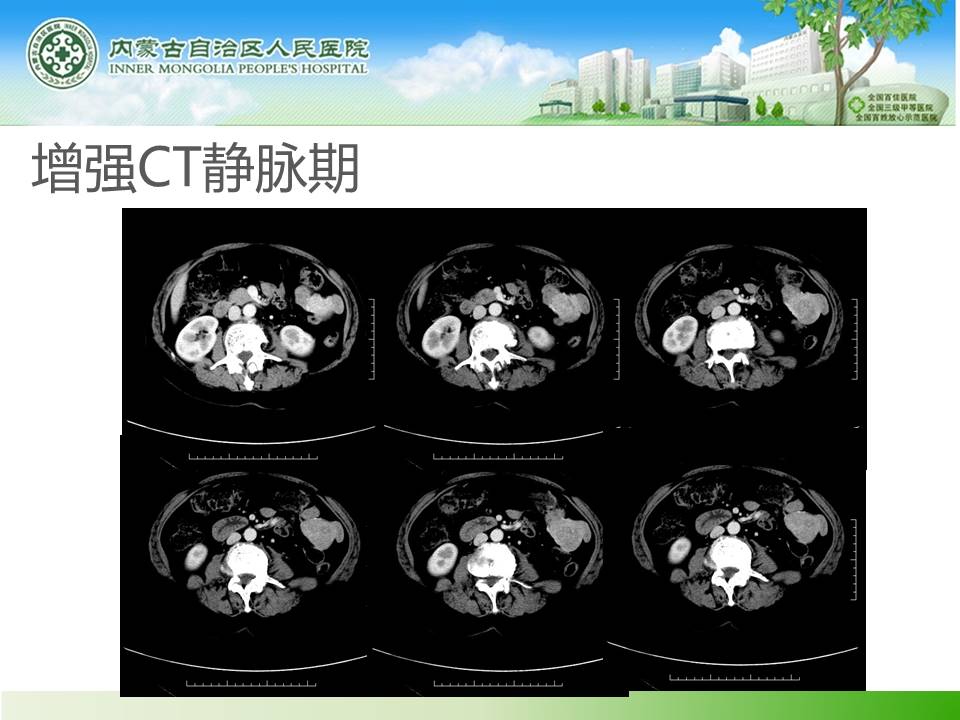 【病例】小肠间质瘤1例CT