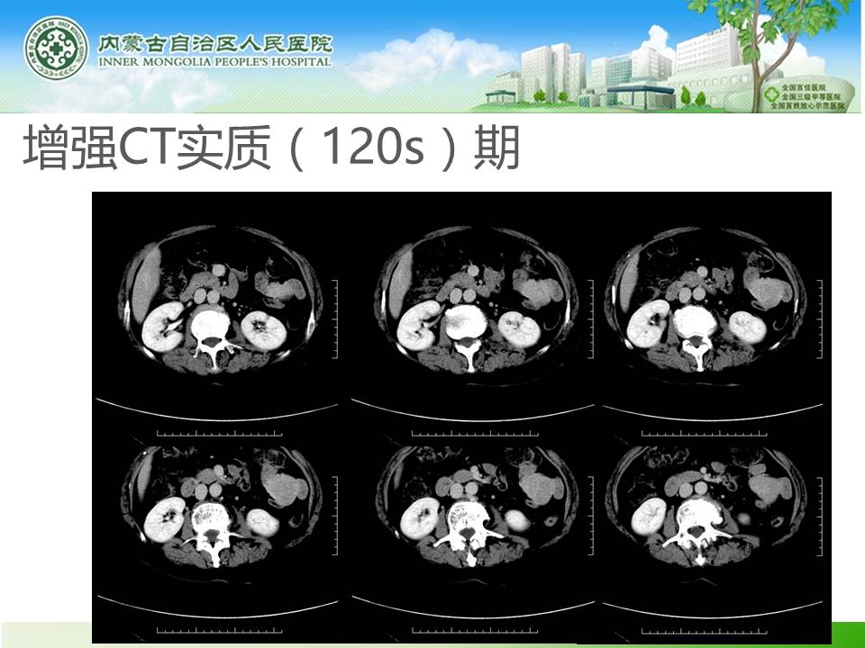 【病例】小肠间质瘤1例CT